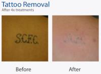 Laser Tattoo Removal Leicester image 9